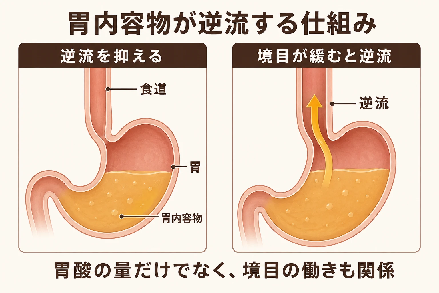 胃と食道の境目が逆流を抑える状態と、境目が緩んで胃内容物が食道へ上がる状態を比較した模式図