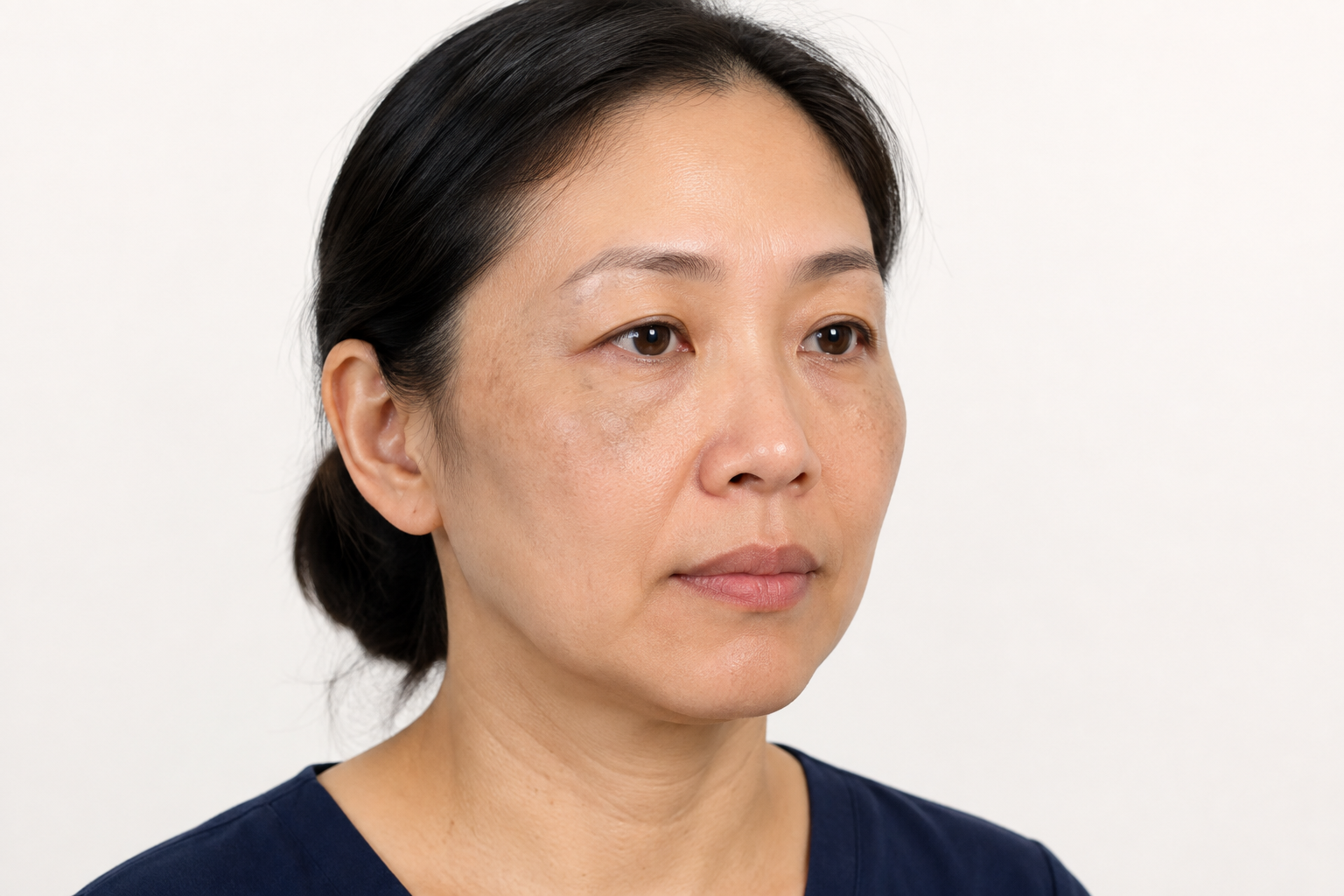 両側の頬骨部やこめかみの色素斑を確認する成人女性のイメージ